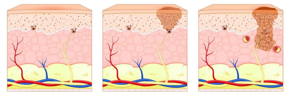 Camadas da pele com melasma